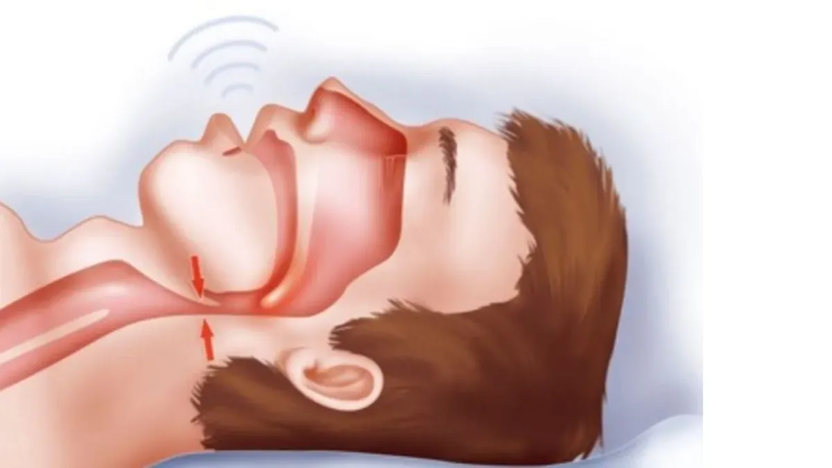 Cấu trúc giải phẫu vùng hàm mặt có thể là nguyên nhân dẫn đến ngáy