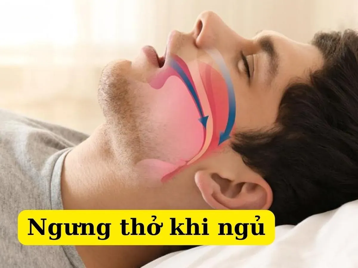 Minh họa đường thở bị hẹp gây ngáy và ngưng thở khi ngủ