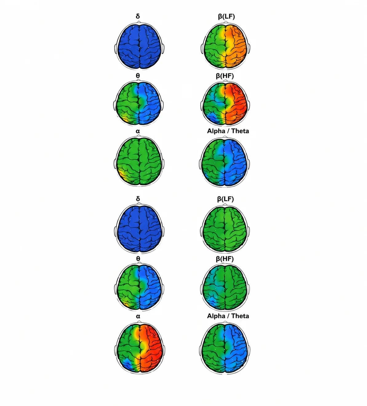 Bản đồ địa hình điện não EEG theo các dải tần delta, theta, alpha và beta