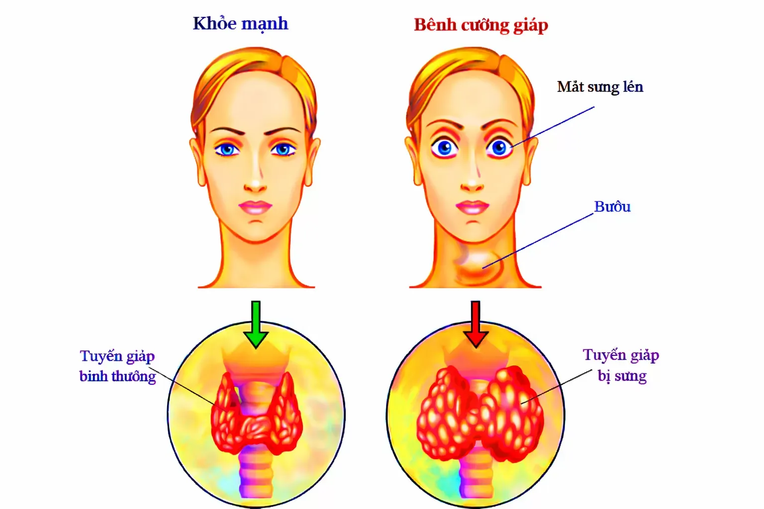 Triệu chứng và dấu hiệu nhận biết cường giáp