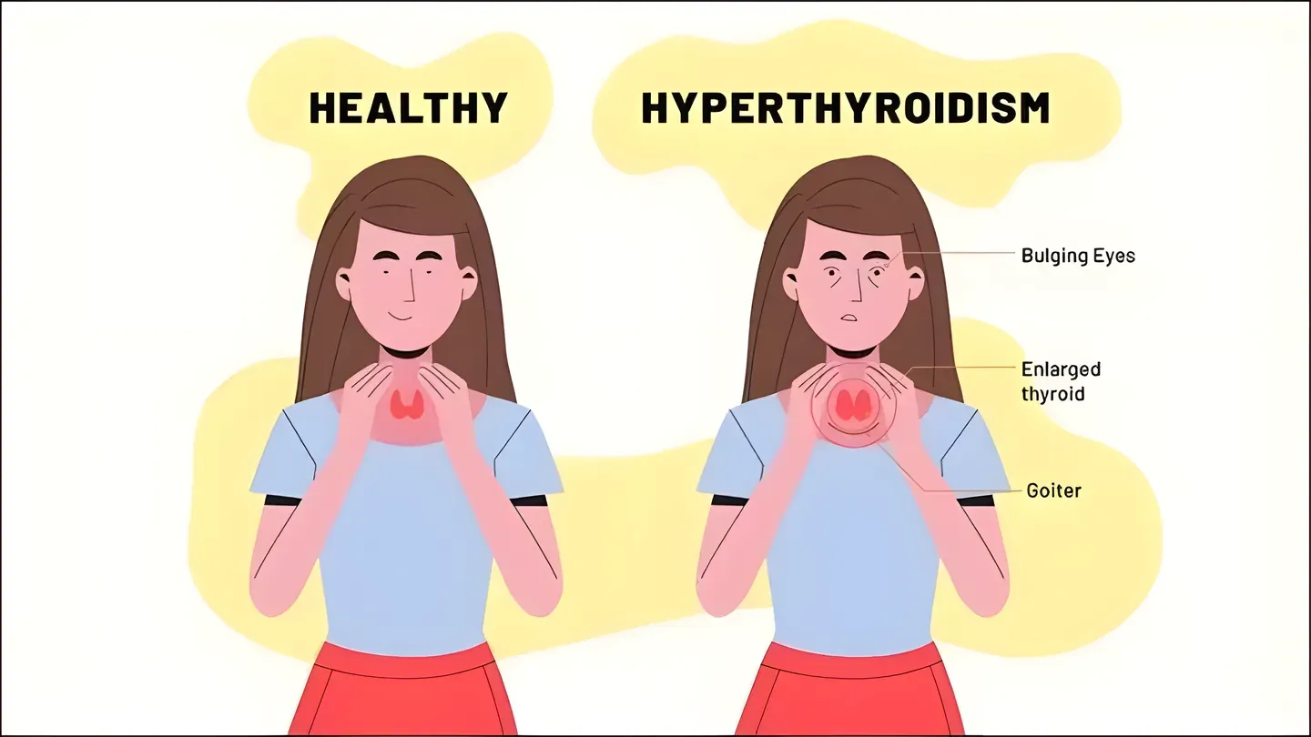 Cường giáp là gì? Nguyên nhân, triệu chứng và điều trị