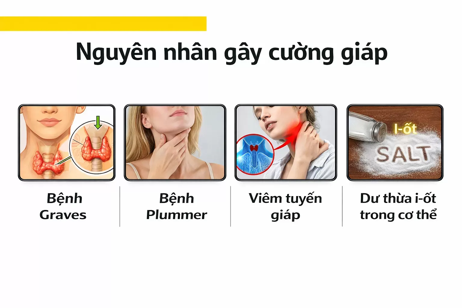 Nguyên nhân gây bệnh cường giáp thường gặp