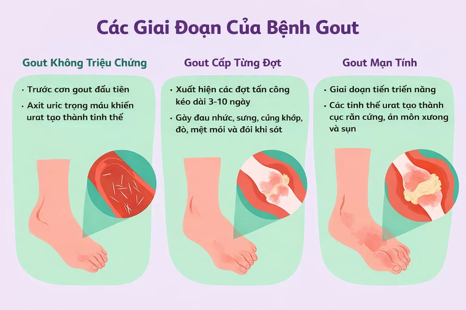 Diễn tiến các giai đoạn của bệnh gút