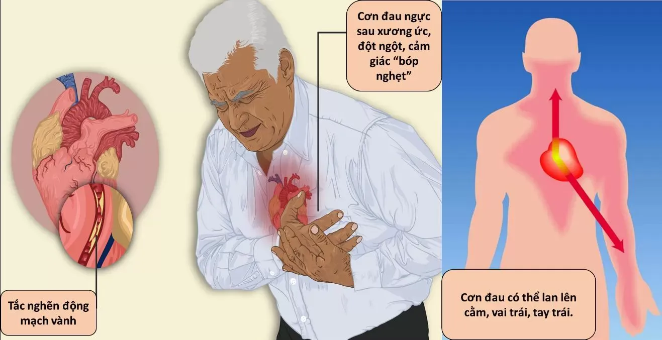 Những dấu hiệu sớm nhận biết cơn đau của bệnh mạch vành