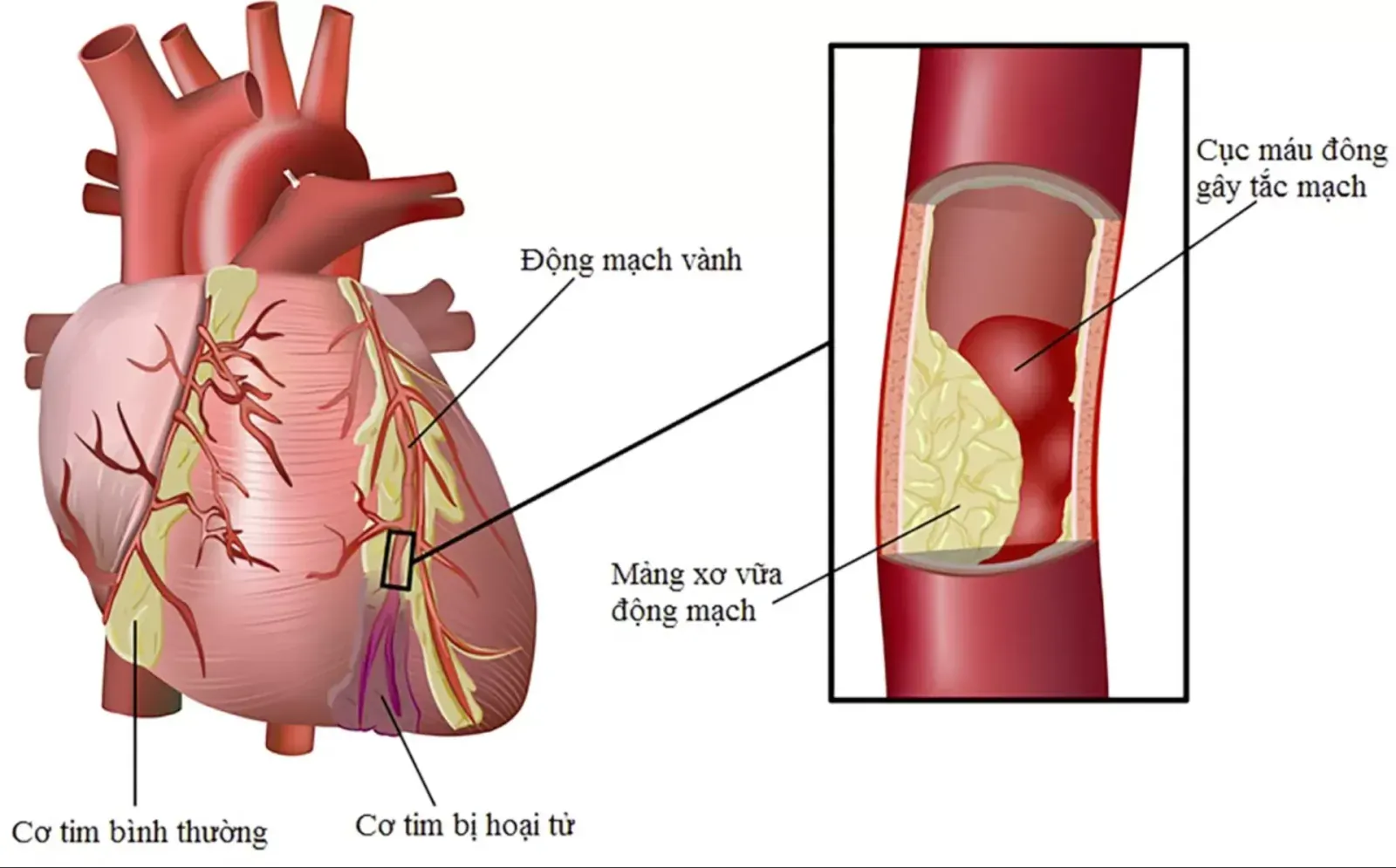 Bệnh mạch vành là gì