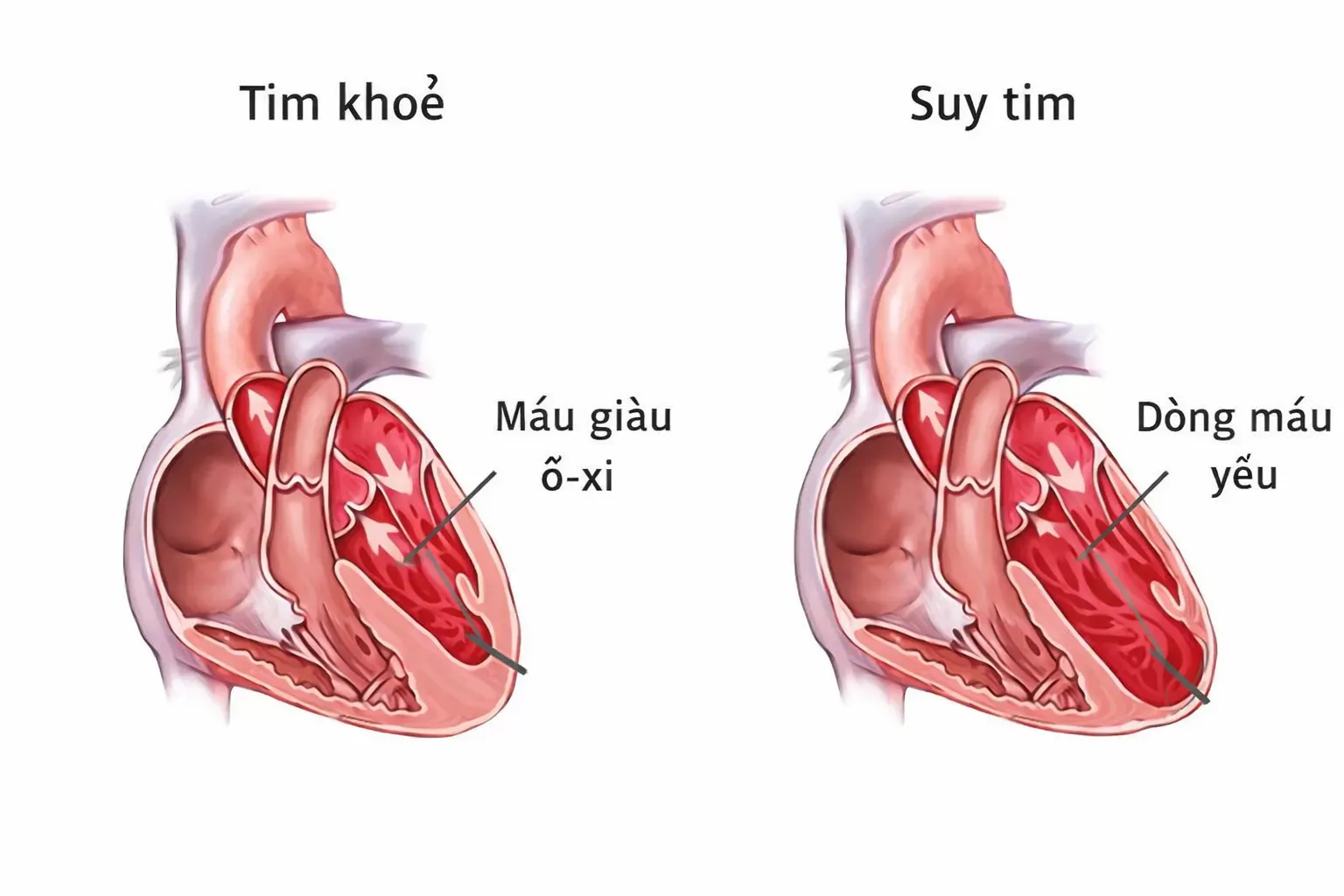 Suy tim là tình trạng gì?