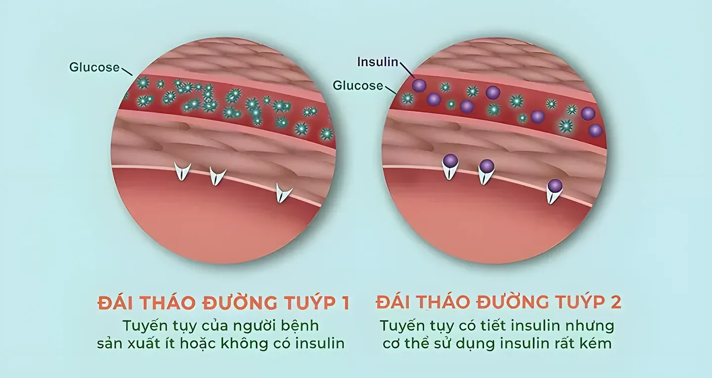 Phân biệt tiểu đường tuýp 1 và tuýp 2