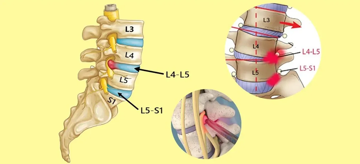 Giải phẫu cột sống thắt lưng thấp với các tầng đĩa đệm L4–L5 và L5–S1