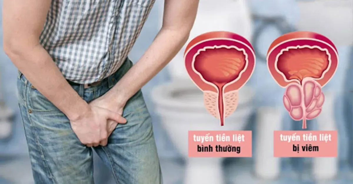 Minh họa tuyến tiền liệt bình thường và tuyến tiền liệt bị viêm