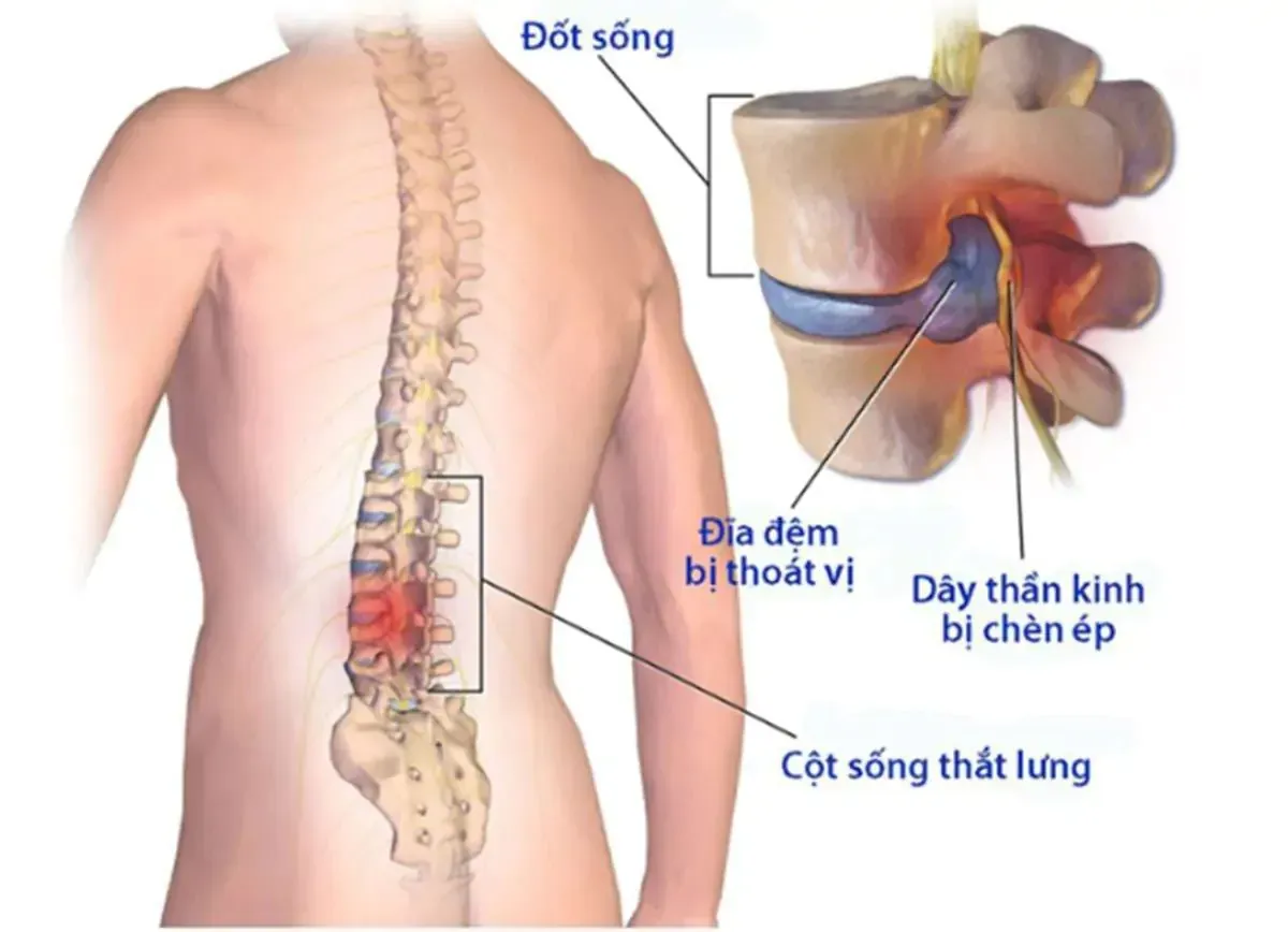 Đau lưng dưới là đau vùng thắt lưng