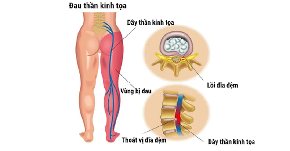 Đau lưng lan xuống mông và chân do rễ thần kinh tọa bị chèn ép