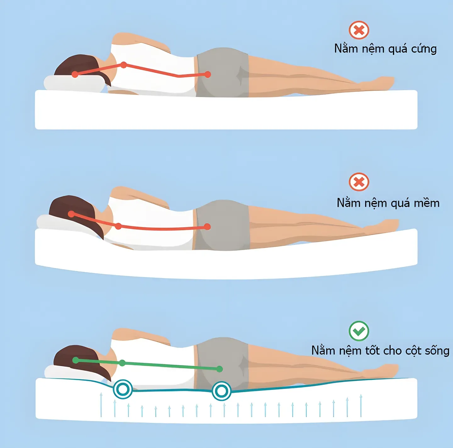 Sơ đồ so sánh đường cong cột sống khi nằm nệm quá cứng, nệm quá mềm và nệm phù hợp