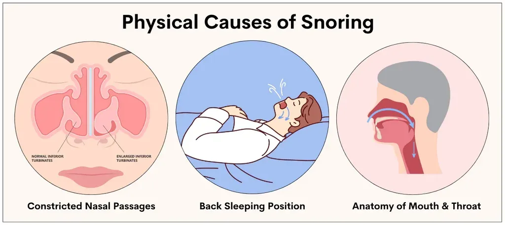 Minh họa ba nhóm nguyên nhân gây ngáy: nghẹt mũi, tư thế nằm ngửa và cấu trúc miệng họng