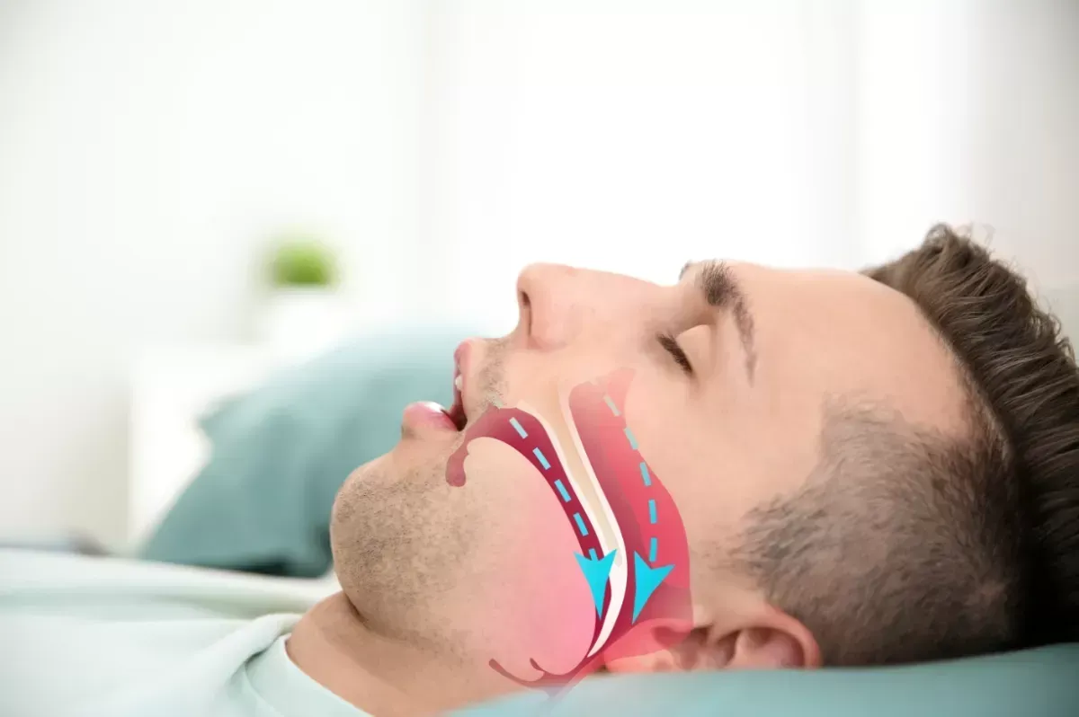 Thở bằng miệng thay vì bằng mũi dễ khiến người ngủ bị chảy nước miếng khi ngủ