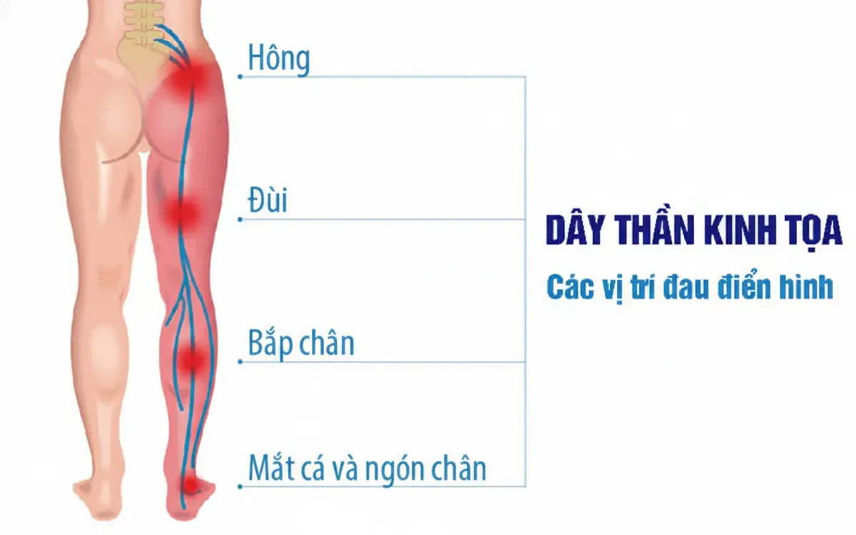 Đường đi của dây thần kinh tọa và các vị trí đau điển hình