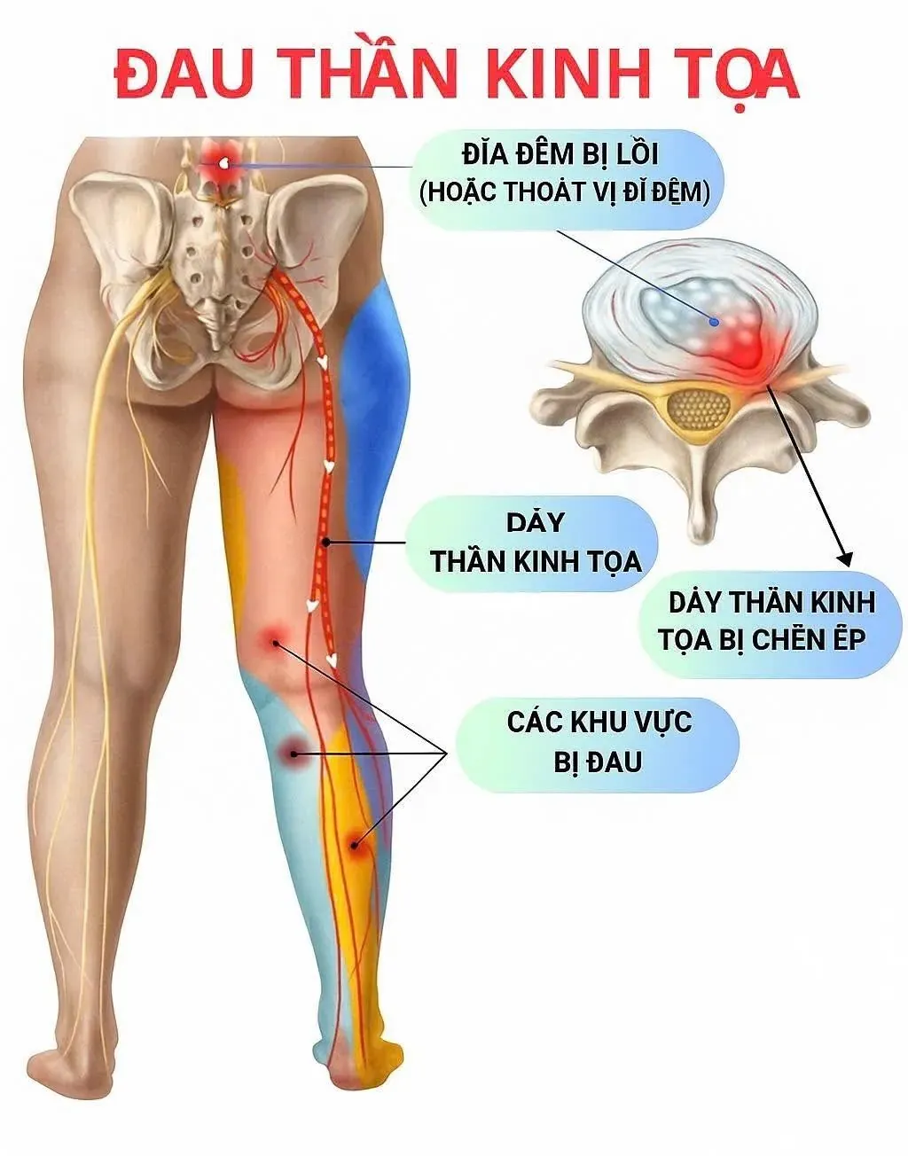 Đau dây thần kinh tọa có thể gặp ở bất kỳ đối tượng nào