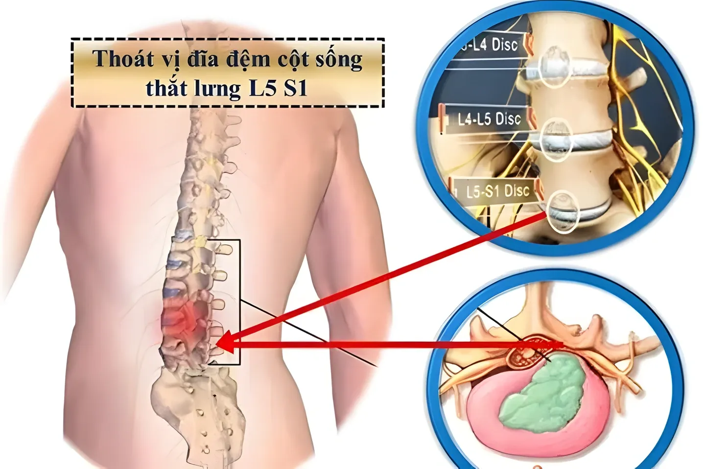 Đây là các biểu hiện điển hình của thoát vị đĩa đệm thắt lưng, với nguy cơ yếu và teo cơ nếu chèn ép kéo dài.