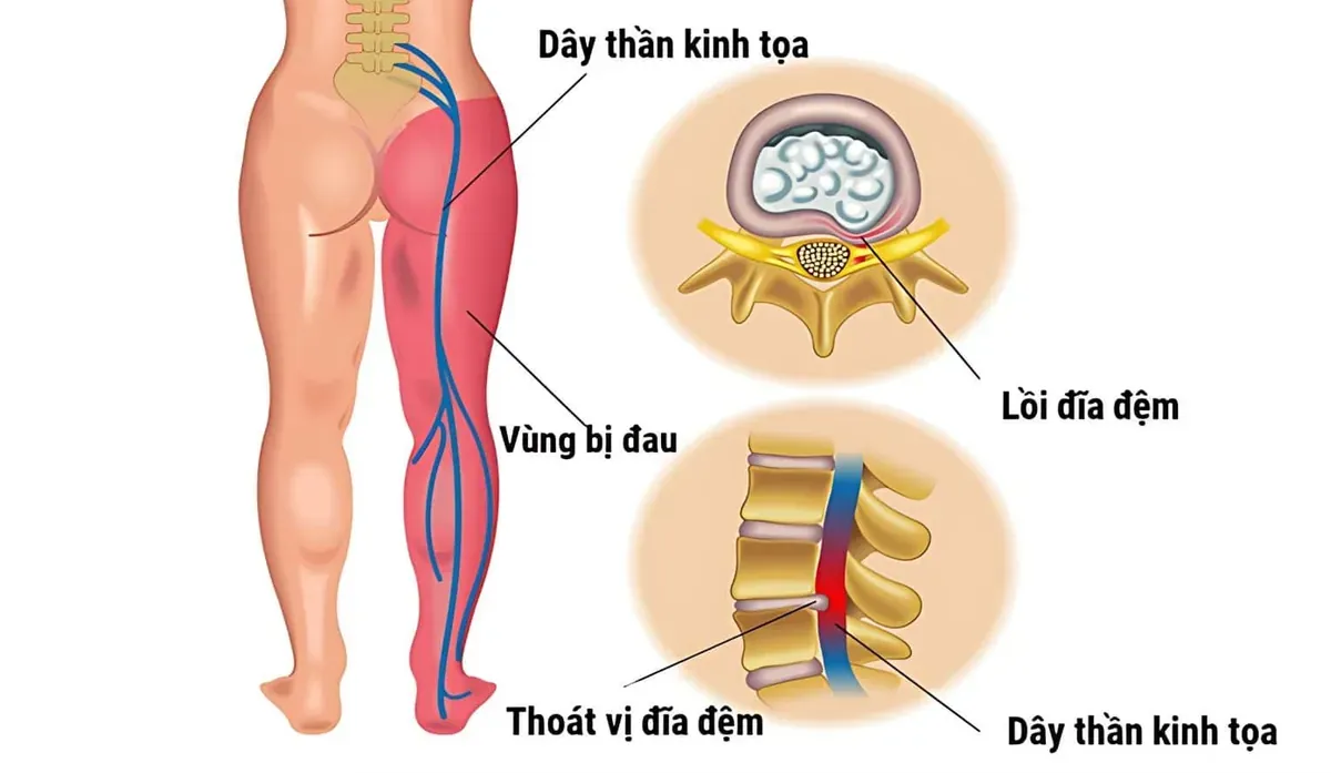 Đau thần kinh tọa do thoát vị đĩa đệm thắt lưng thường lan từ mông xuống mặt sau đùi và cẳng chân