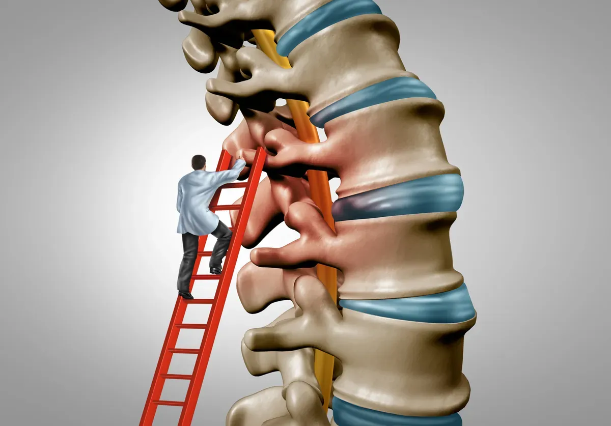 Hẹp ống sống thắt lưng là tình trạng không gian bên trong ống sống bị thu hẹp lại