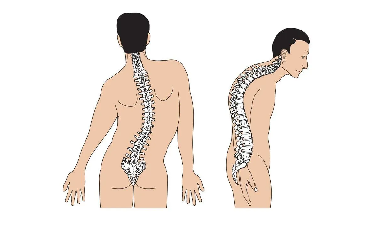 Cong vẹo cột sống có thể dẫn đến đau lưng mạn tính