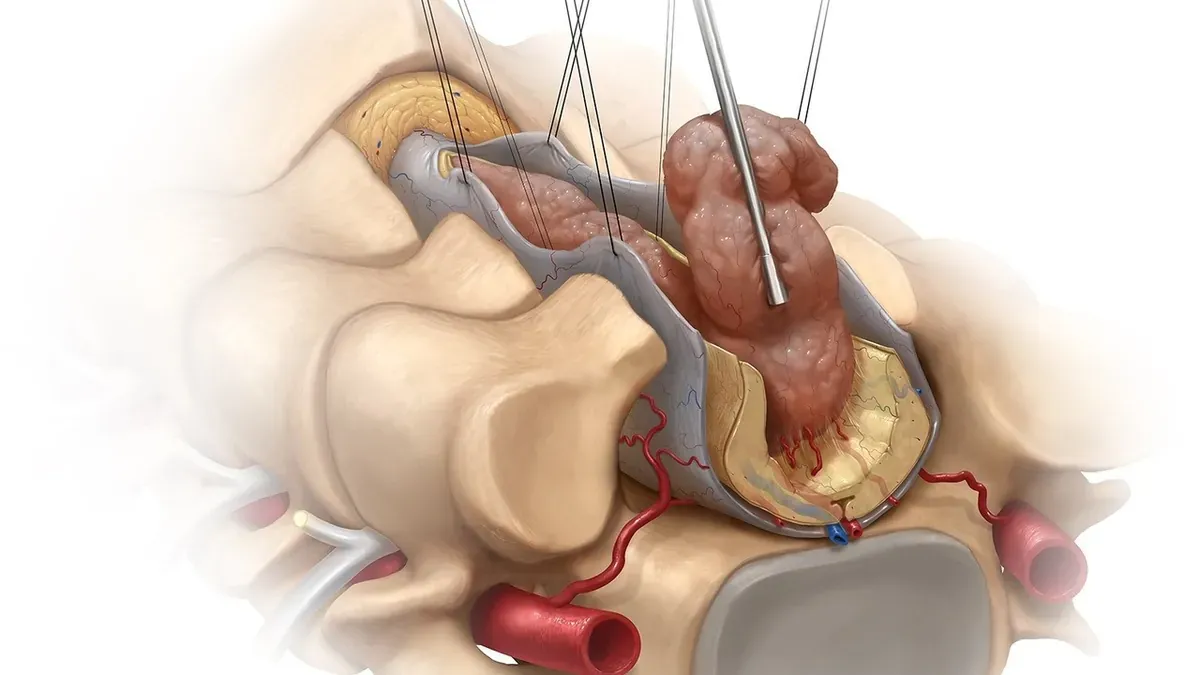 Dù là u lành hay u ác thì khối u cột sống cũng gây nên những cơn đau lưng dữ dội