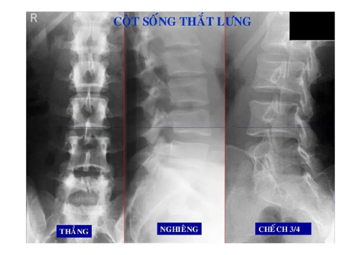 Chụp X-quang là một trong những bước quan trọng giúp bác sĩ chẩn đoán chính xác vùng và nguyên nhân gây đau lưng bên trái
