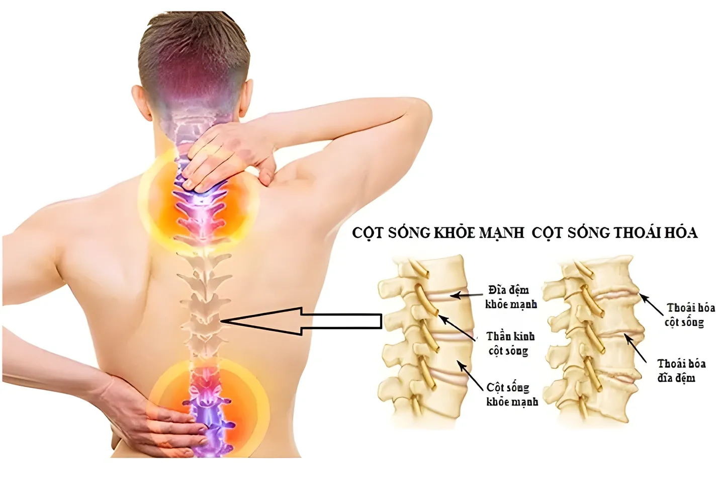 Thoái hóa cột sống và thoát vị đĩa đệm là nguyên nhân gây đau lưng giữa phổ biến
