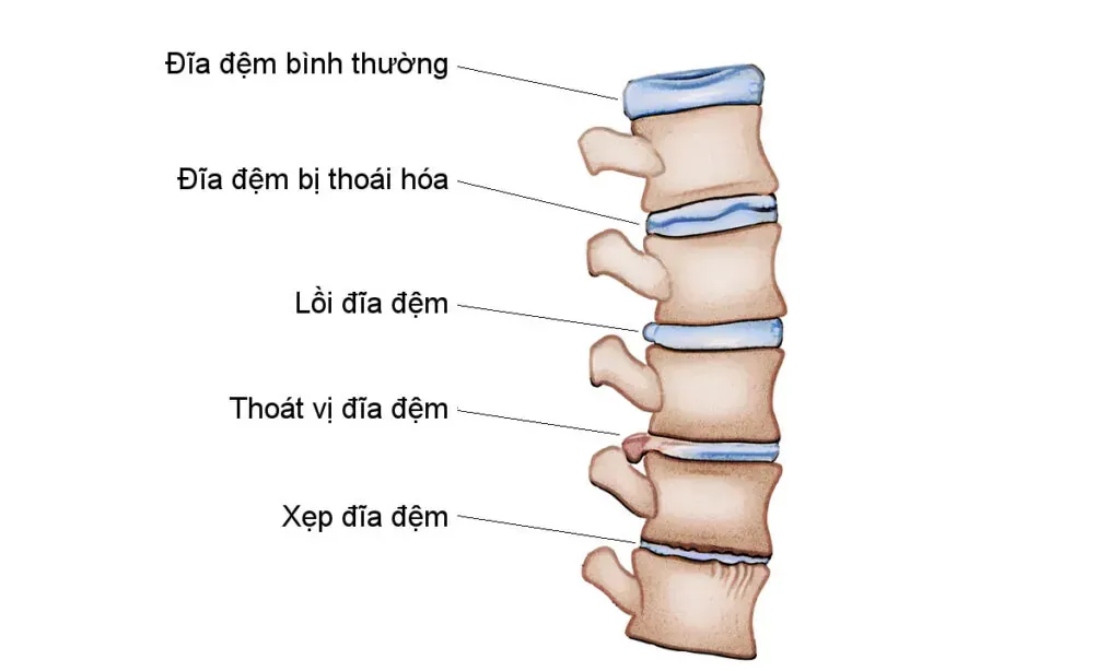 Thoát vị đĩa đệm là một nguyên nhân dẫn đến đau lưng trên