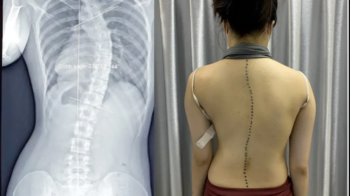 Biến dạng cột sống là một biến chứng thường gặp khi bị đau lưng trên mà nguyên nhân chủ yếu là do loãng xương hoặc thoái hóa