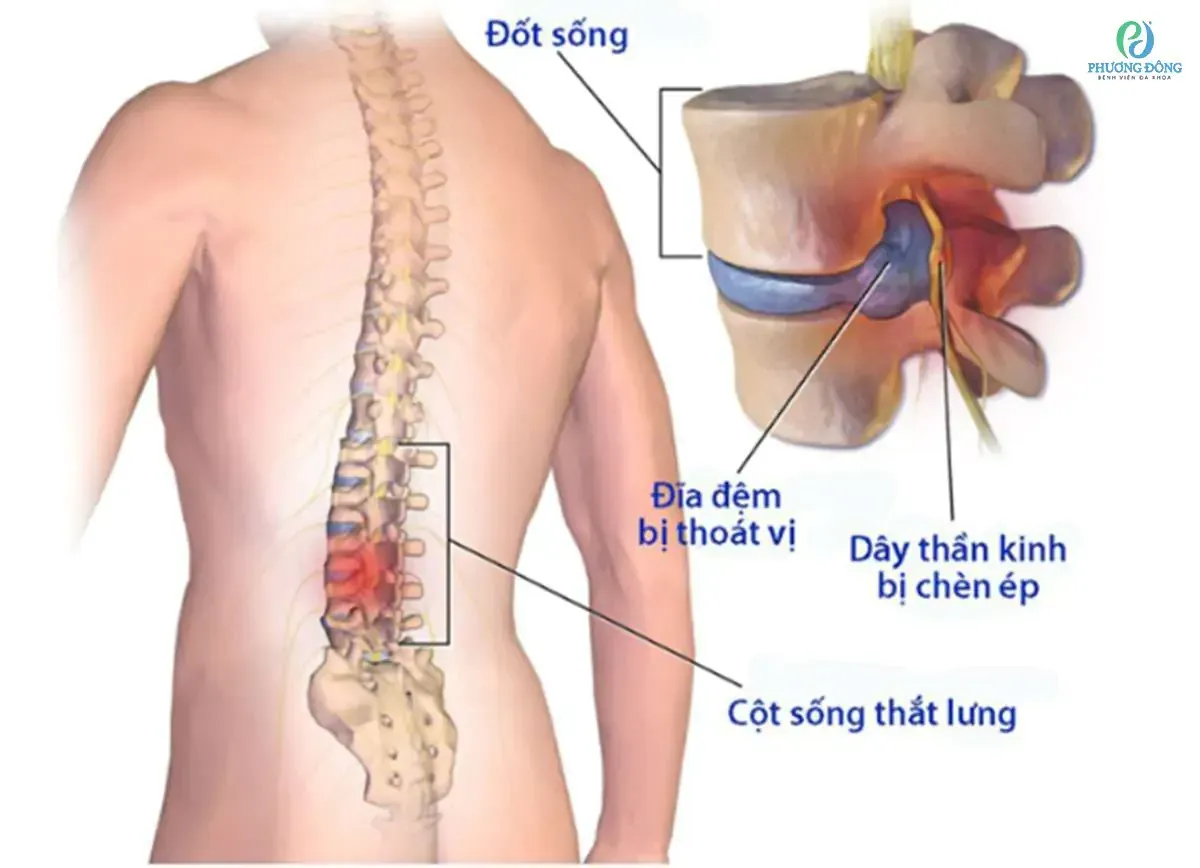 Hình ảnh giải phẫu cột sống thắt lưng, giúp bạn đọc hình dung về các nguyên nhân gây đau thắt lưng