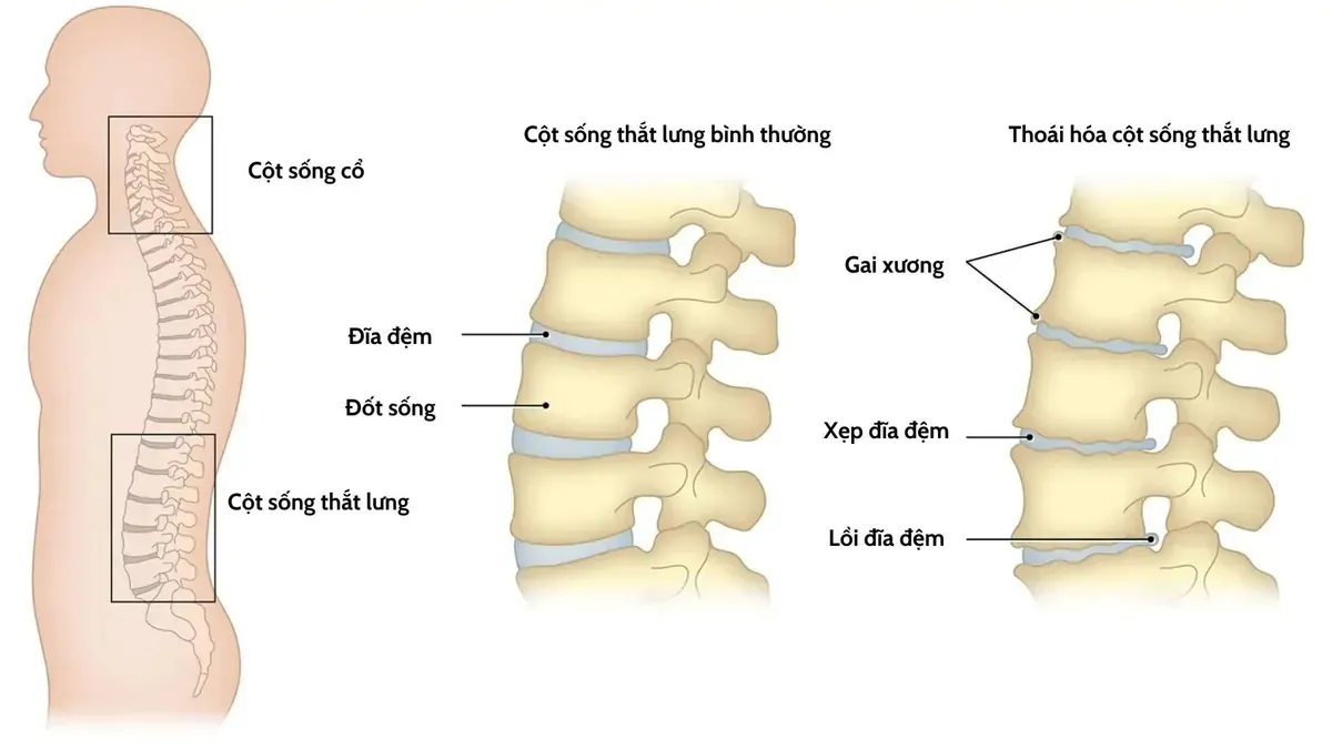 Bệnh lý cơ xương khớp như thoái hóa cột sống lưng là một nguyên nhân gây nên đau thắt lưng bên phải