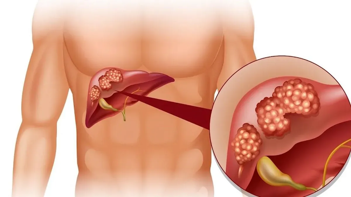 Do vị trí gan nằm phần nhiều ở phía bên phải nên các cơn đau ở gan có thể gây đau lan sang vùng thắt lưng và mạn sườn phải.