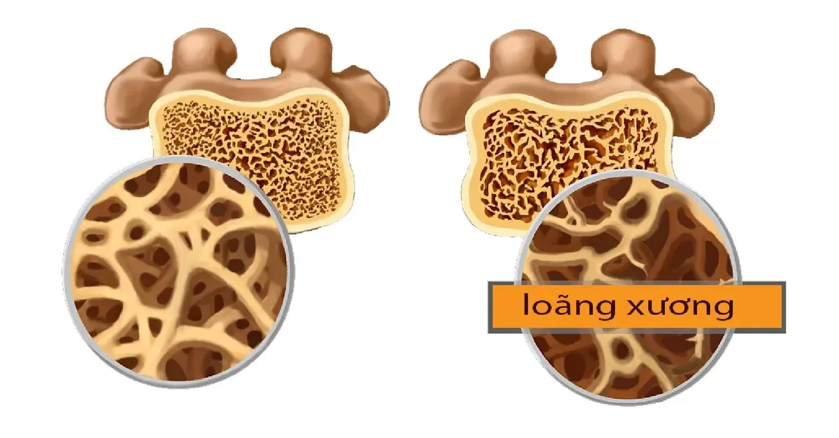 Cấu trúc xương bình thường và xương loãng bên trong thân đốt sống