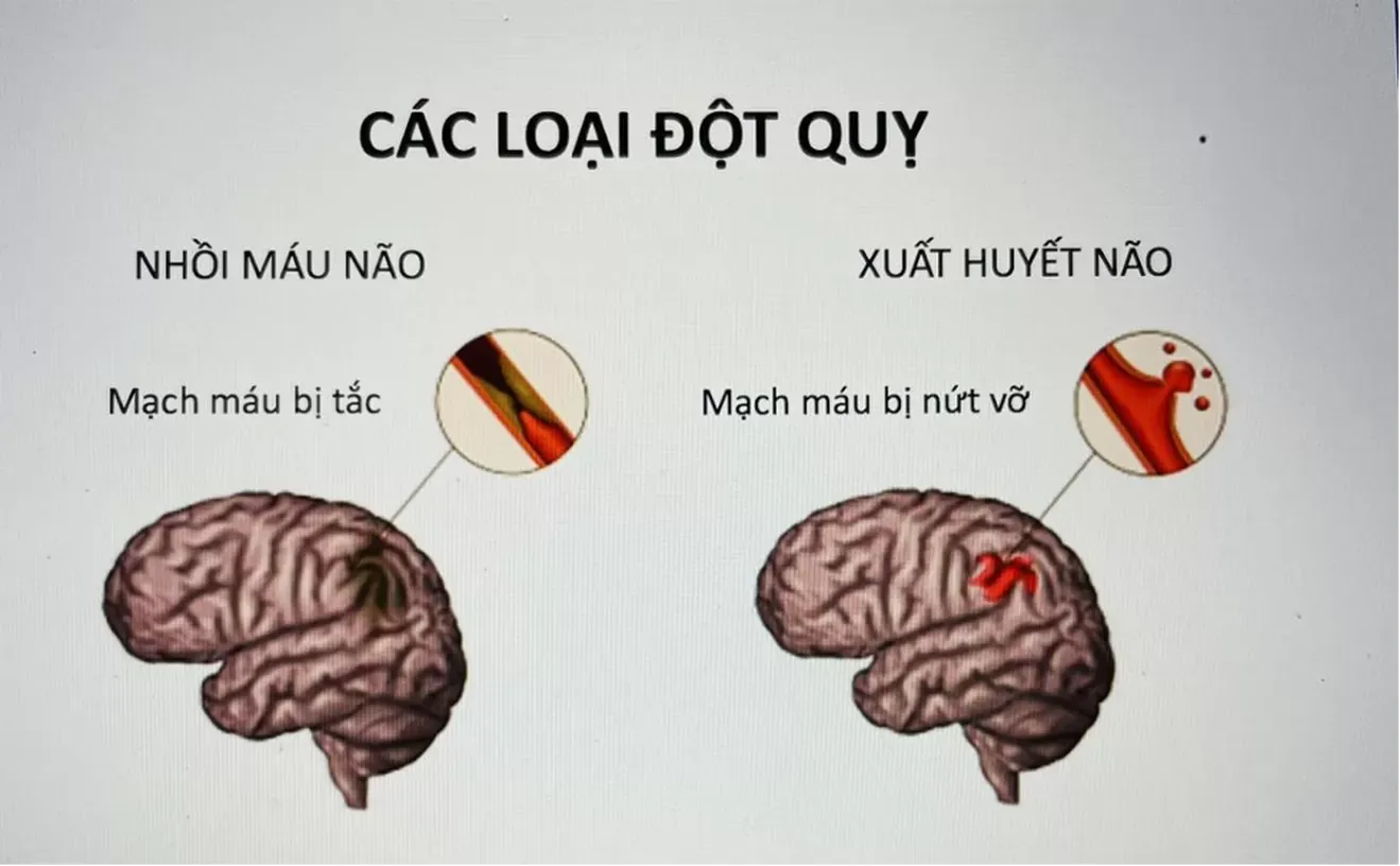 Đột quỵ não là do nhồi máu não hoặc xuất huyết não