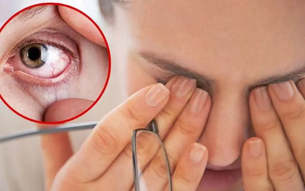Khô mắt xảy ra khi nước mắt không đủ số lượng hoặc chất lượng để bôi trơn và bảo vệ bề mặt nhãn cầu
