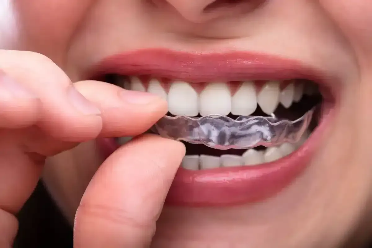 Máng chống nghiến không loại bỏ nguyên nhân gây nghiến răng khi ngủ nhưng là “lá chắn” giúp ngăn ngừa mòn men răng