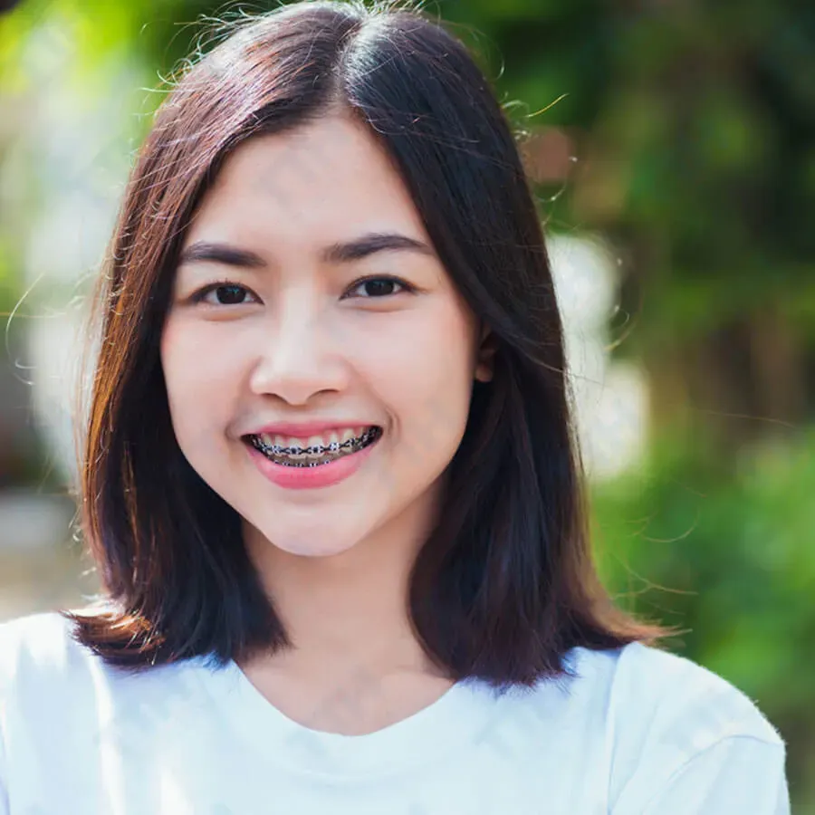 Niềng răng để chỉnh nha cũng giúp bạn sắp xếp lại vị trí các răng, từ đó giảm tải áp lực cho khớp thái dương hàm.