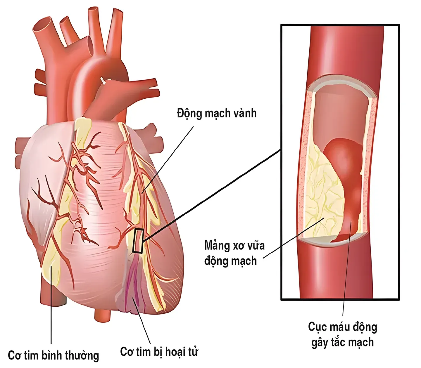 Nguyên nhân gây nhồi máu cơ tim