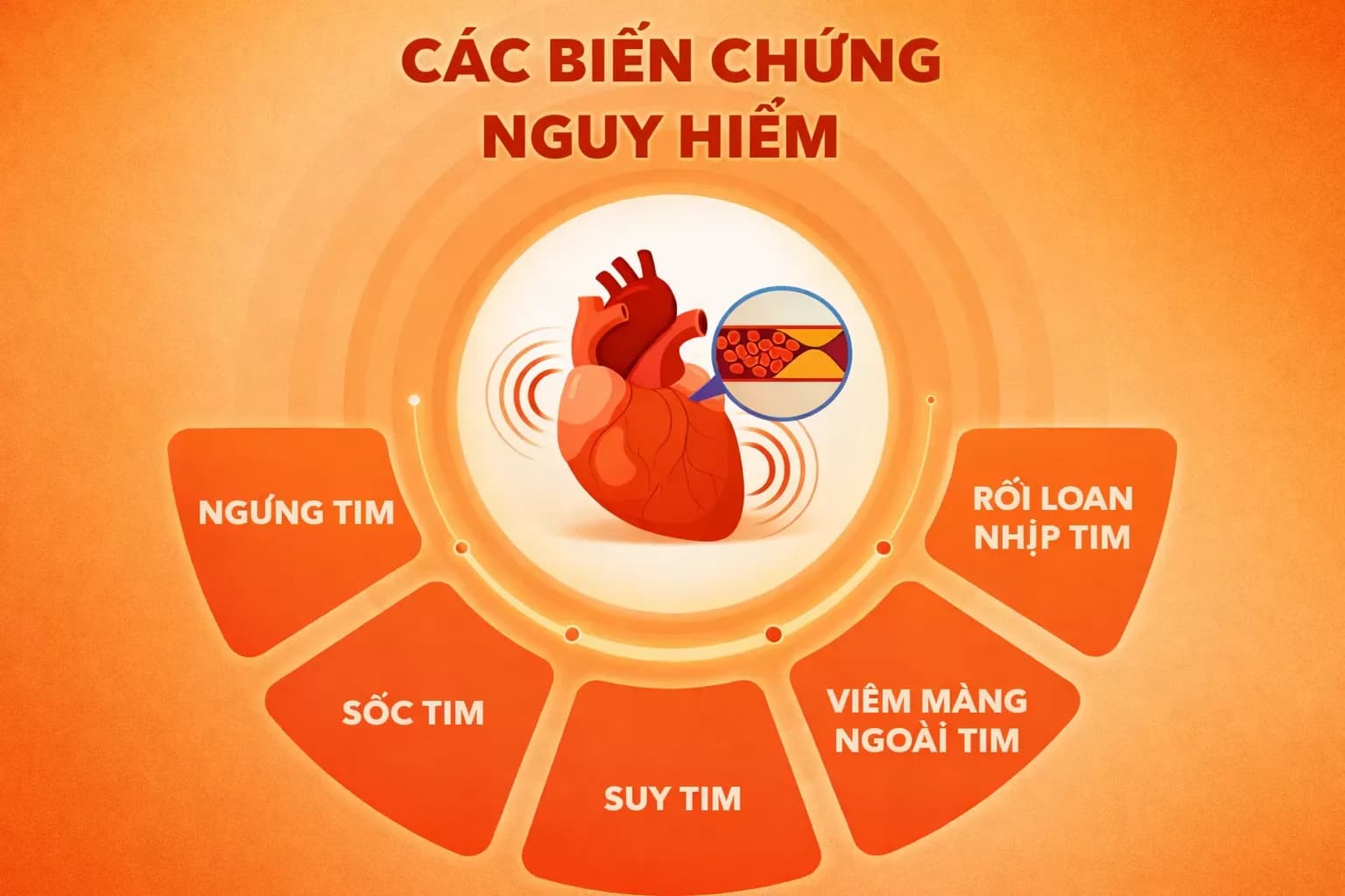 Biến chứng nguy hiểm của nhồi máu cơ tim