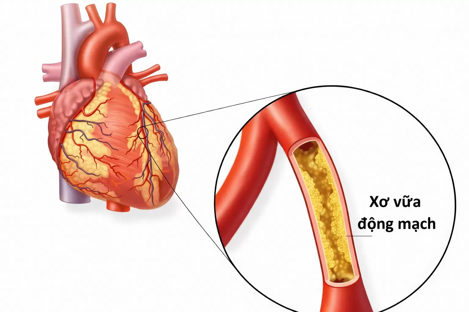 Nhồi máu cơ tim thường khởi phát từ sự hình thành mảng xơ vữa động mạch vành