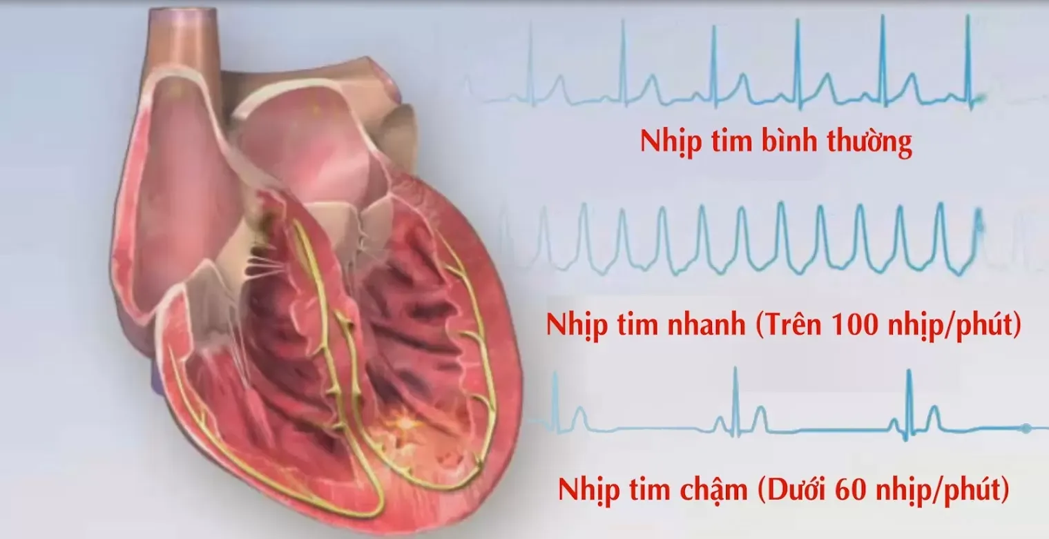 Nhịp tim bình thường và nhịp tim nhanh, nhịp tim chậm