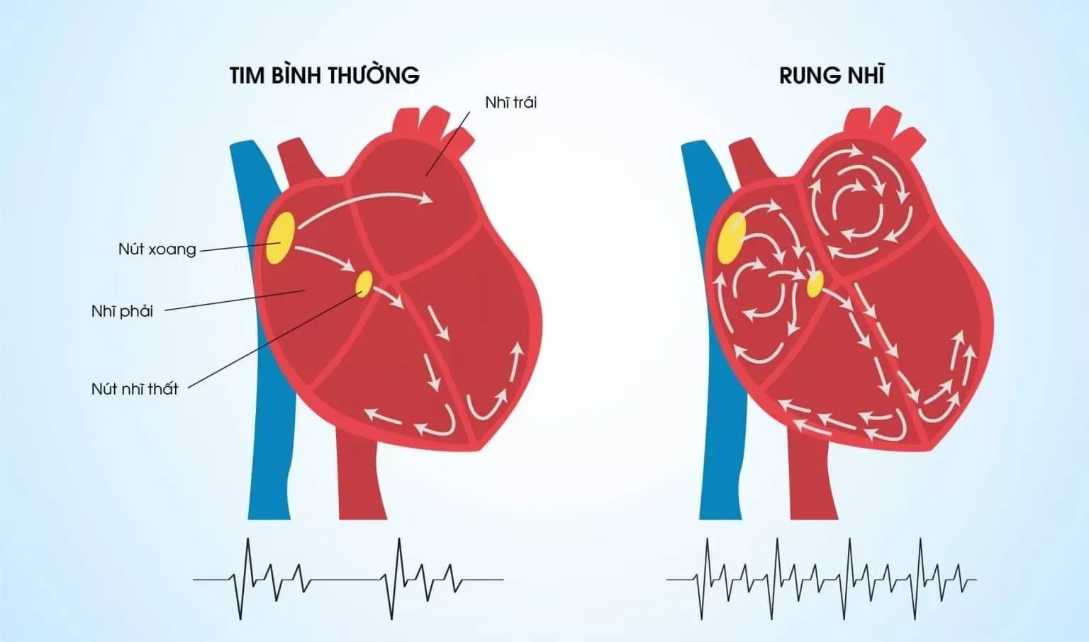 Giải thích hiện tượng rung nhĩ