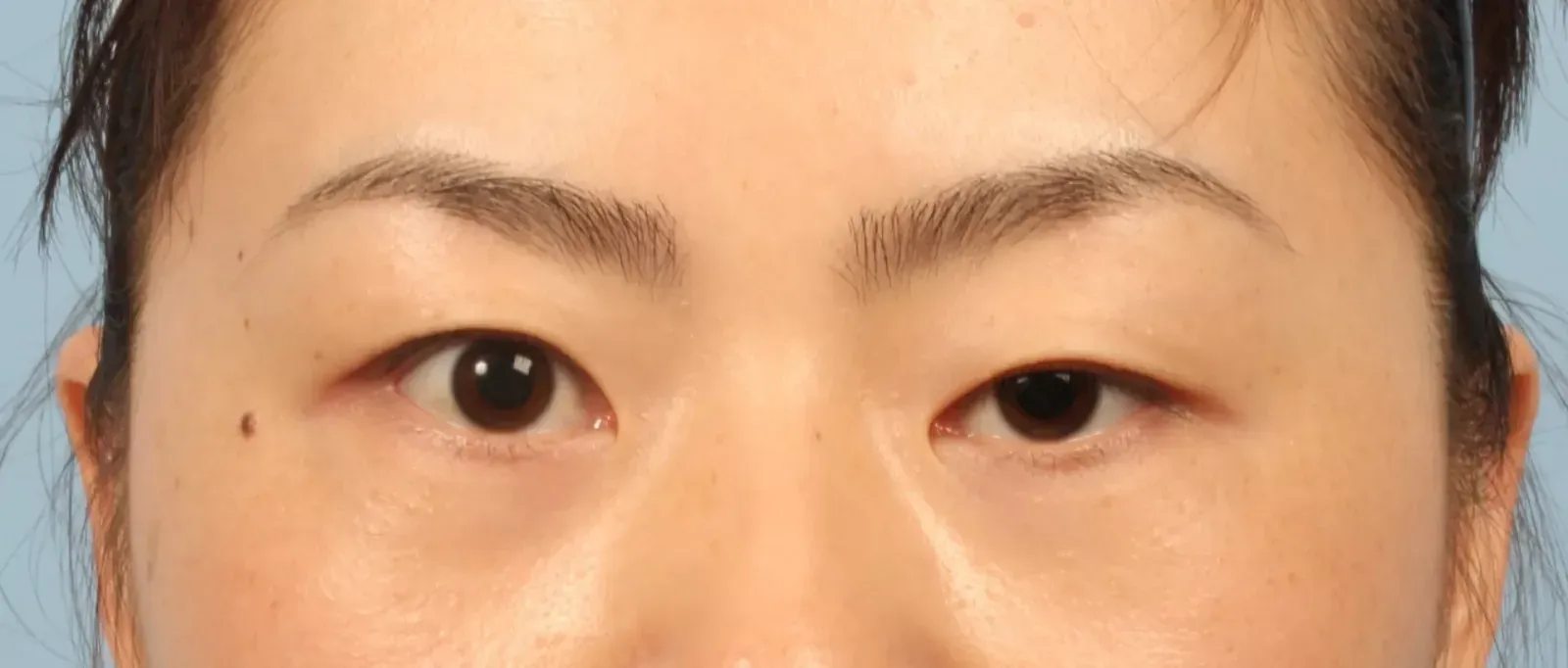 Sụp mí có thể được phân ra thành nhiều loại dựa theo từng cơ chế khác nhau