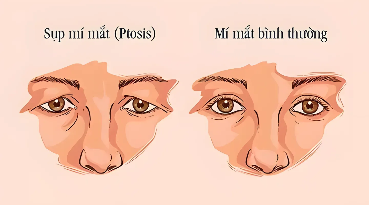Sụp mí mắt có thể gây giảm tầm nhìn rõ rệt, gây khó khăn cho việc đọc sách, lái xe hay quan sát
