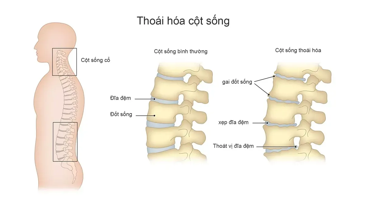 Minh họa các cấu trúc cột sống bị thoái hóa