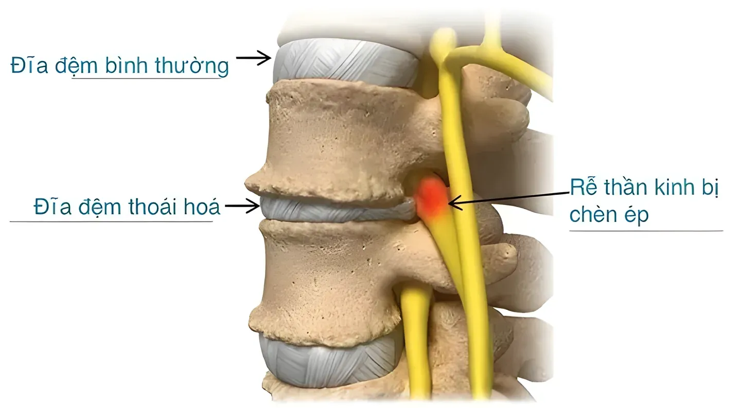 Thoái hoá cột sống kéo dài có thể dẫn đến biến chứng nghiêm trọng như chèn ép rễ thần kinh