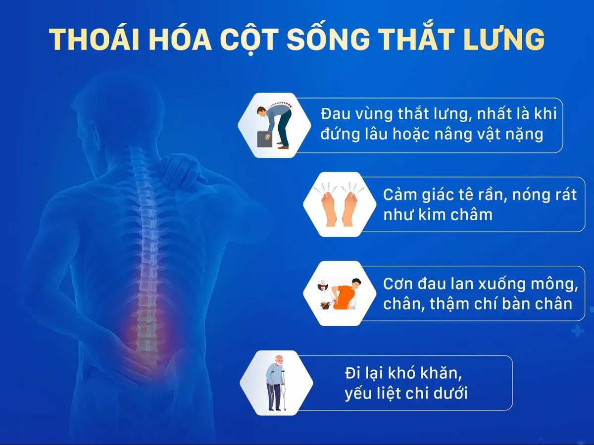 Một vài triệu chứng - dấu hiệu thoái hoá cột sống thắt lưng điển hình