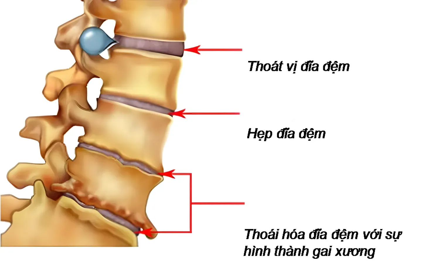 Các tổn thương thường gặp khi cột sống thoái hóa: thoát vị đĩa đệm, hẹp khe đĩa đệm, gai xương