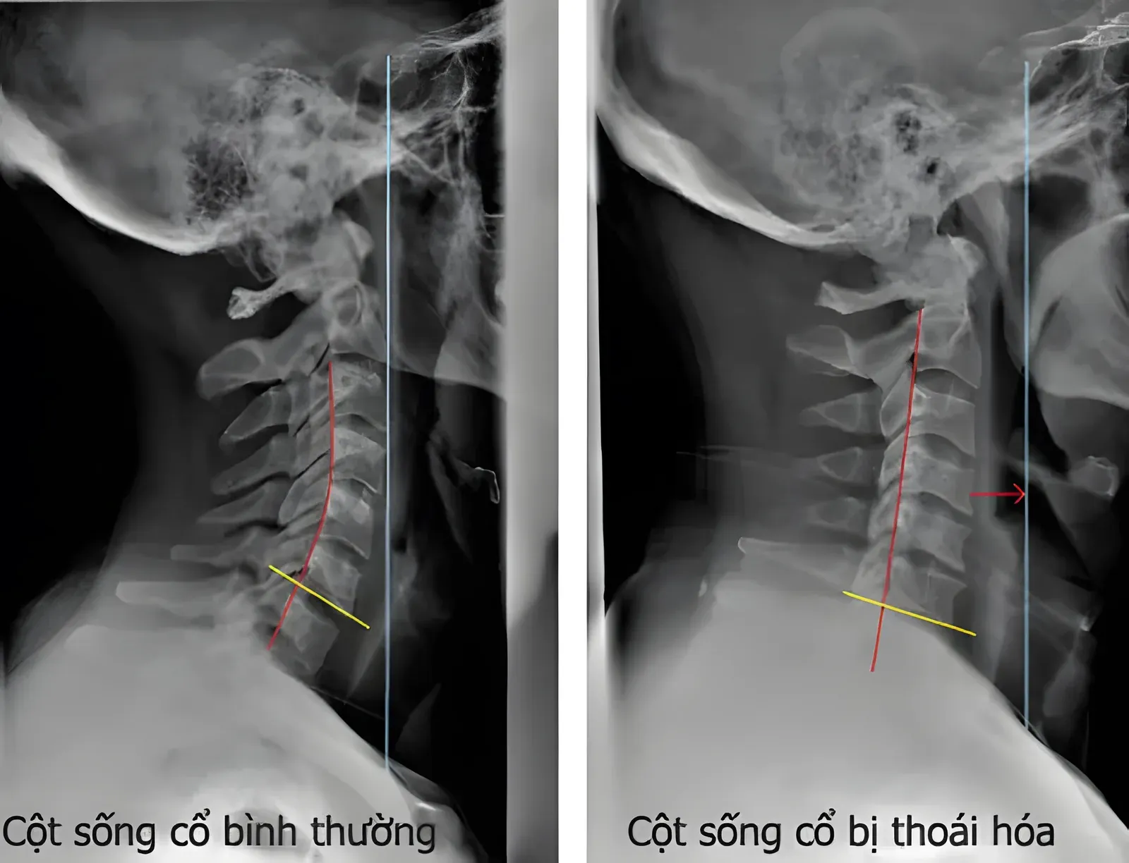 Phim X-quang cột sống cổ bình thường và cột sống cổ bị thoái hóa