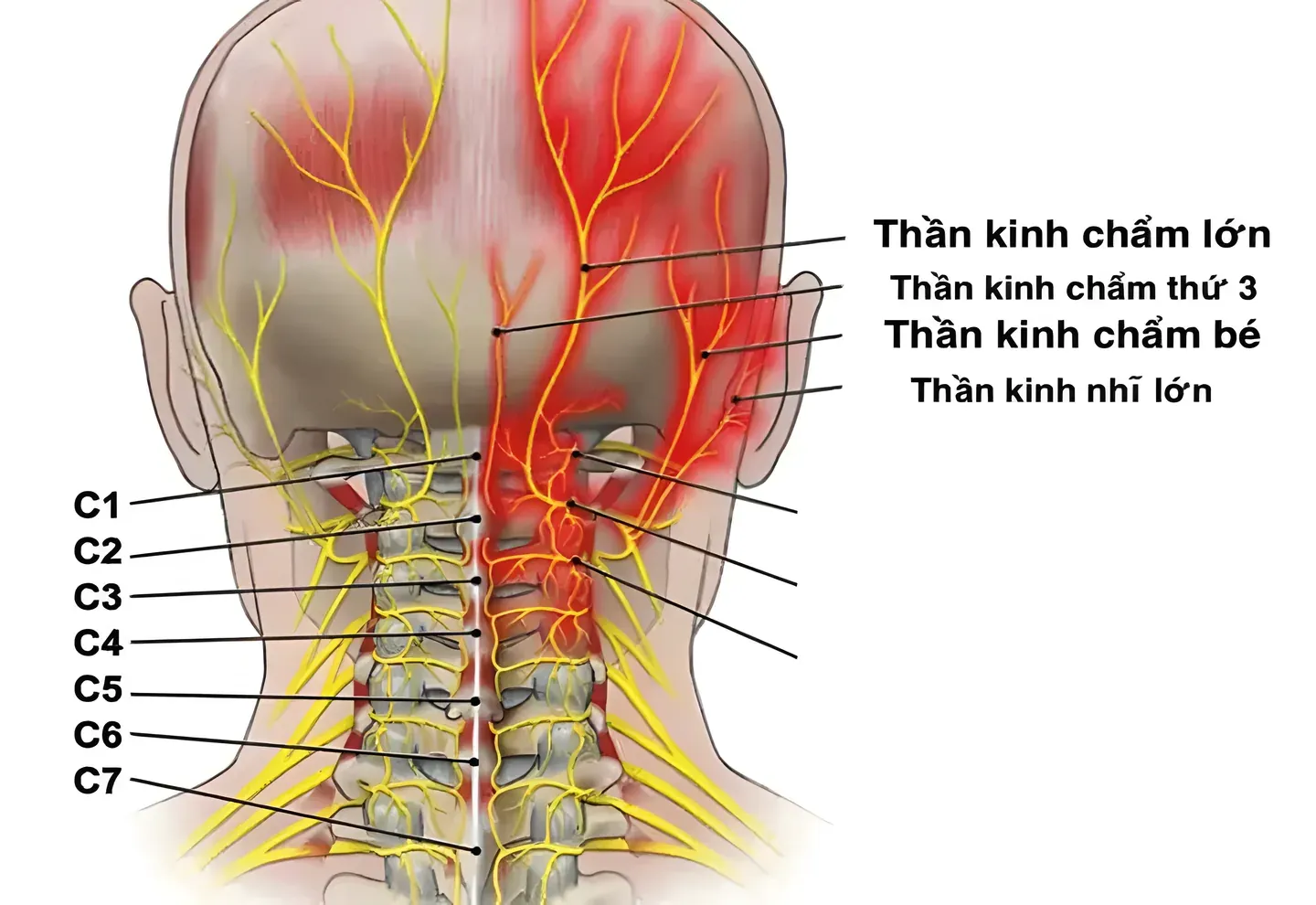 Thoái hóa đốt sống cổ thường tác động mạnh nhất vào các rễ thần kinh đi ra từ các khe đốt sống